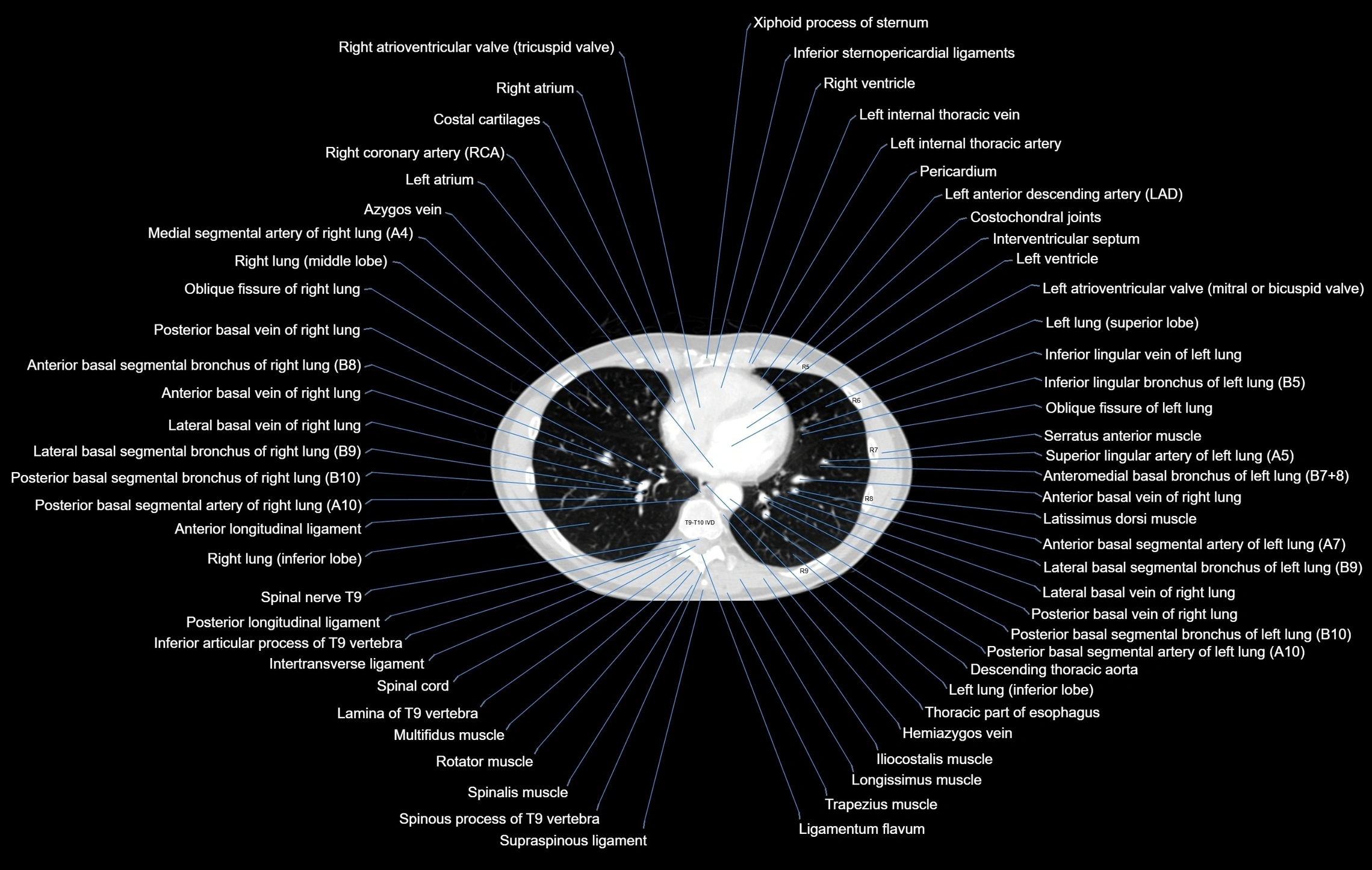 CT chest (thorax) labelled axial cross sectional anatomy radiology image-00079.webp